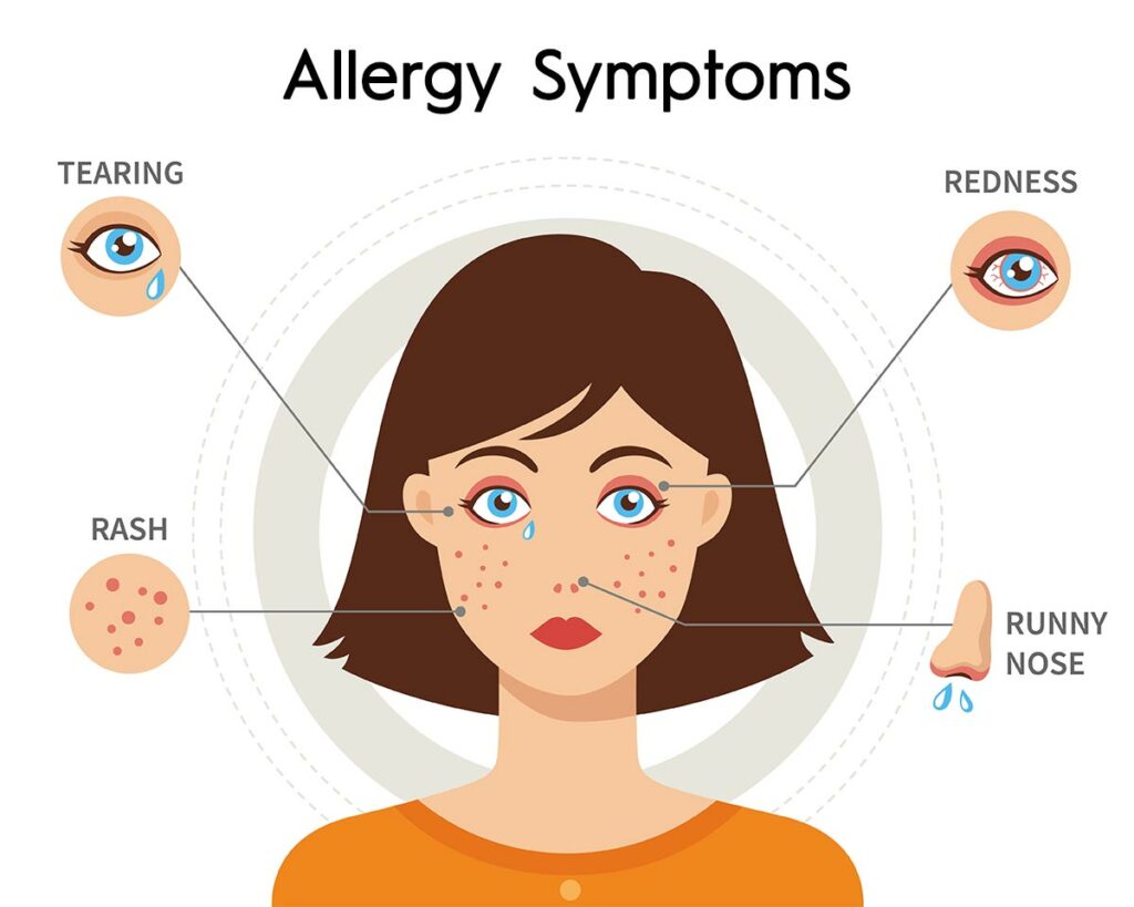 What is an Allergy?